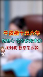 牛皮癬十五六年別擔(dān)心它會(huì)好起來的的找到你教你怎么做