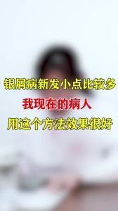 银屑病新发小点比较多我现在的病人用这个方法效果很好