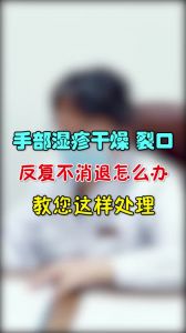 手部濕疹干燥裂口反復(fù)不消退怎么辦教您這樣處理