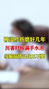 被濕疹折磨好幾年厲害時(shí)候滿手水泡緩解病情記住三不要