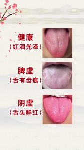 中医教你从舌苔辨别身体状况