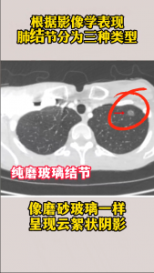 肺结节分为3种类型