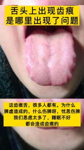 舌头出现齿痕是哪里出现了问题