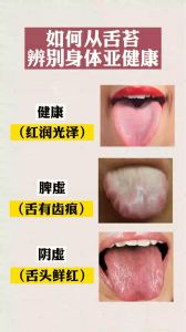 如何从舌苔辨别身体亚健康