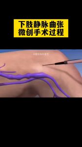 3D下肢静脉曲张微创手术过程