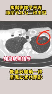 肺结节分为3种类型