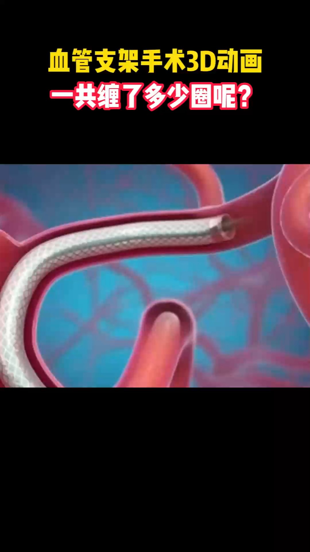 血管支架手术3D动画