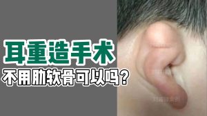 耳重造手术不用助软骨可以吗?