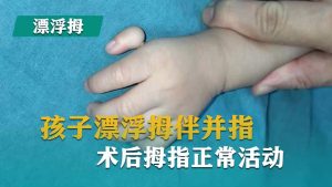 孩子漂浮拇伴并指术后拇指正常活动