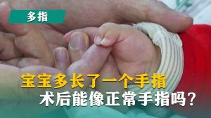 宝宝多长了一个手指术后能像正常手指吗