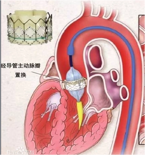 经导管主动脉瓣置换示意图