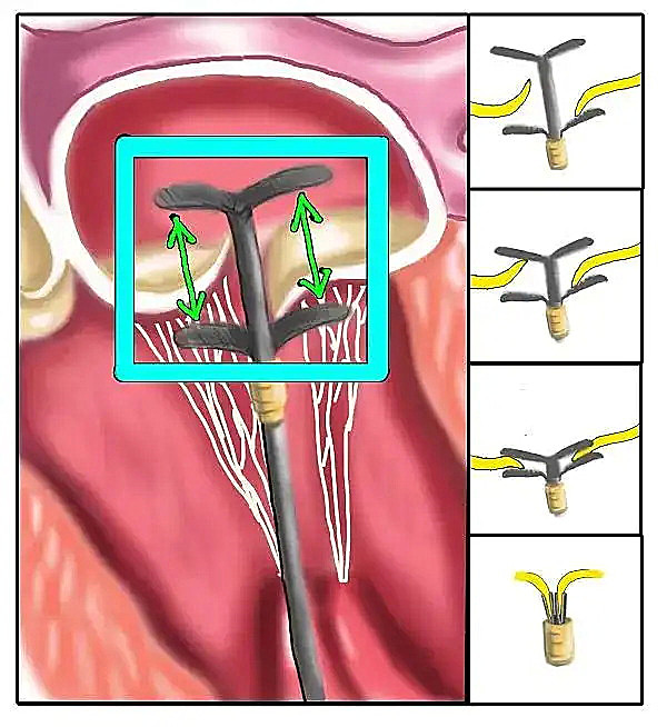 二尖瓣反流导管介入治疗示意图