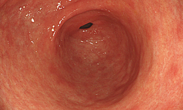 A型胃炎胃镜图