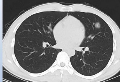 病毒性肺炎CT表现图