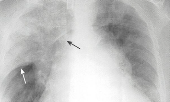 大叶性肺炎消散期胸片图