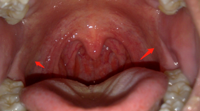 扁桃体位于人的口腔中,在口咽两侧,腭舌弓和腭咽弓之间的三角形间隙内