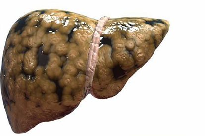 脂肪肝图