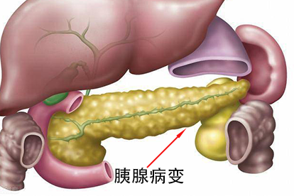 胰腺病變圖