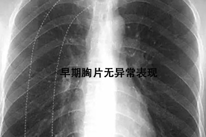 大叶性肺炎充血期胸片图